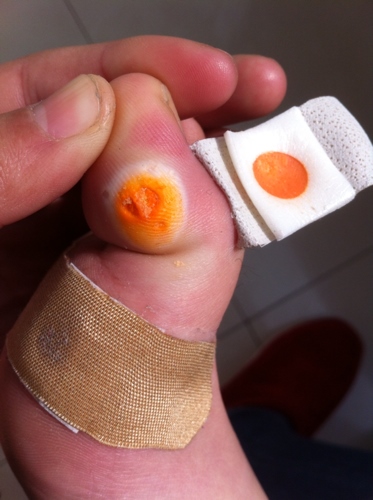 2、脚底长了鸡眼，贴了鸡眼贴之后去掉白色的，发现凸起的那部分中间有很芽一样的东西