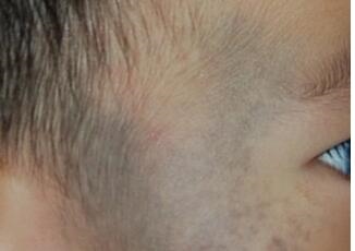 1、新生儿红色胎记图片症状有哪些