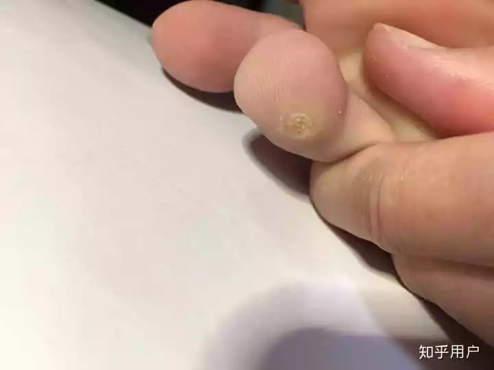 4、用了鸡眼贴，出现了一大块白色的。