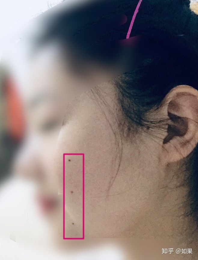 2、胸前有三星痣是什么意思