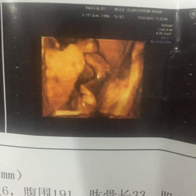 2、四维彩超男孩女孩