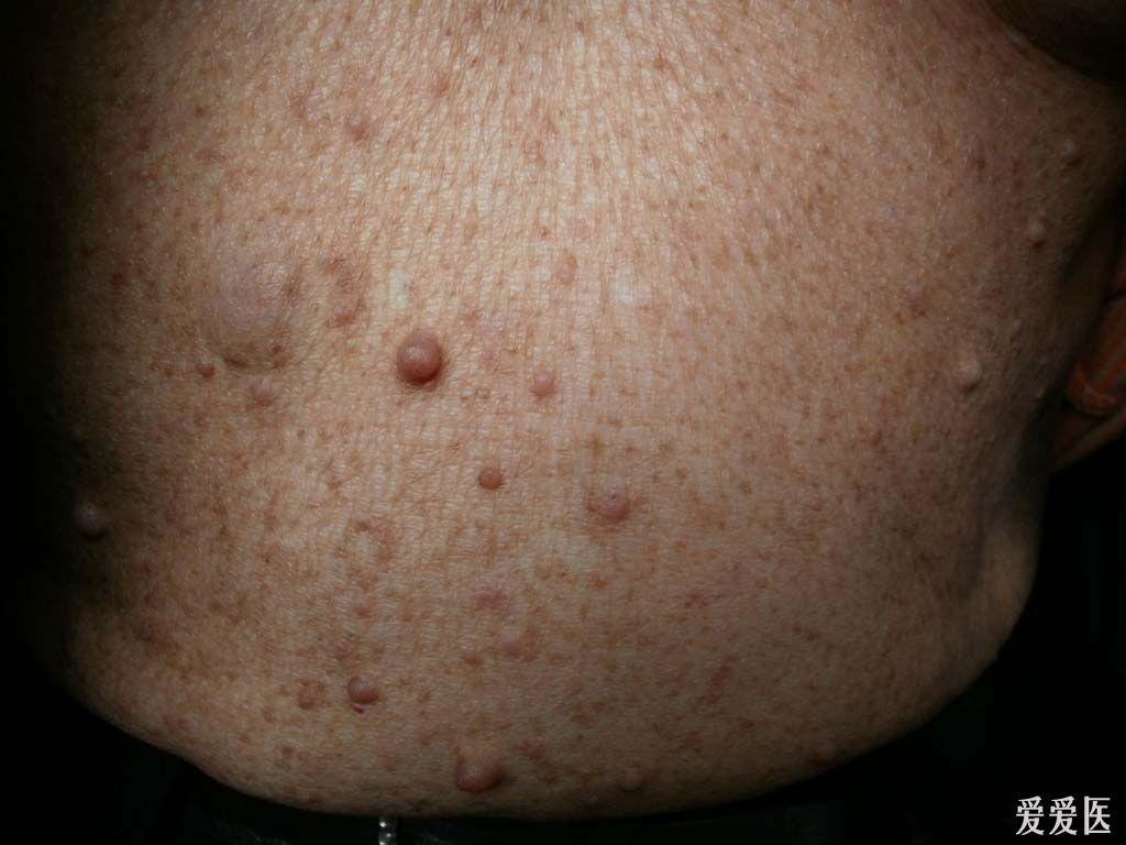 1、长了纤维瘤要不要割掉?