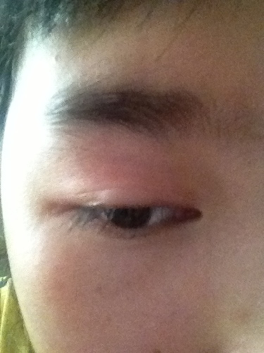 2、小孩额头磕了个大包是要热敷还是冷敷好的快