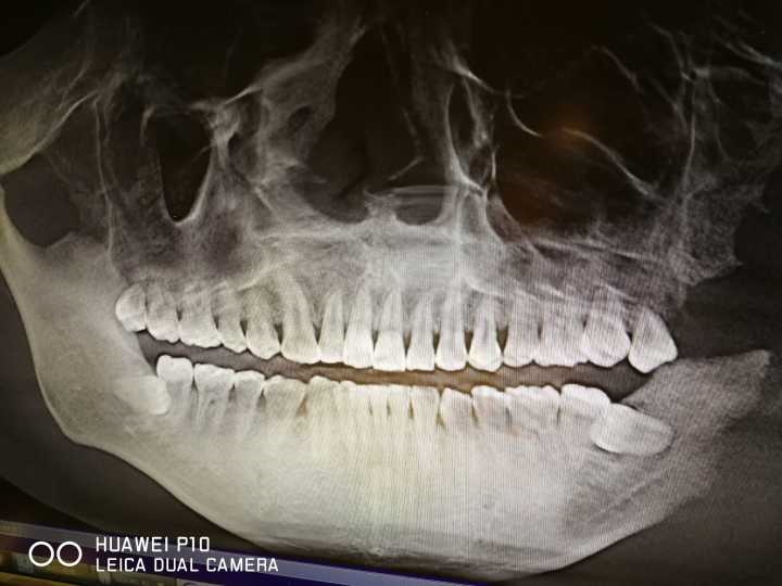 2、你们如何看人的智齿与人的寿命有关？