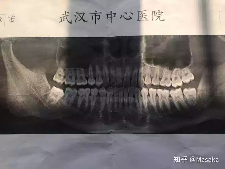 3、20岁了长牙齿？