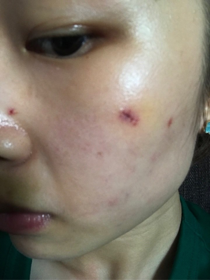 1、关于点痣·！