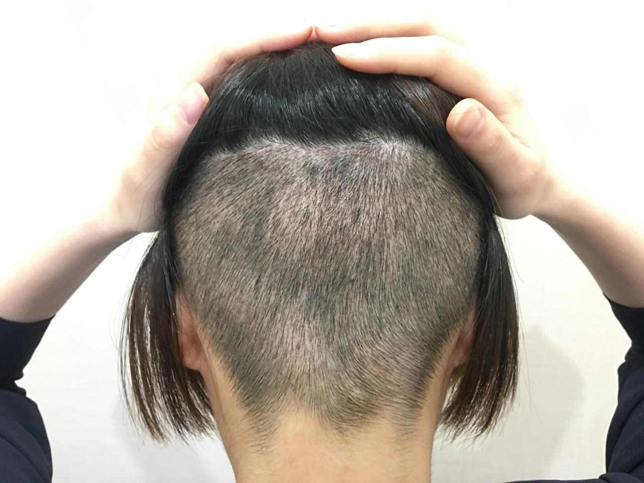 2、我头发一直在掉，感觉都没怎么长，这样下去怕是要秃了，你们觉得植发怎么样？