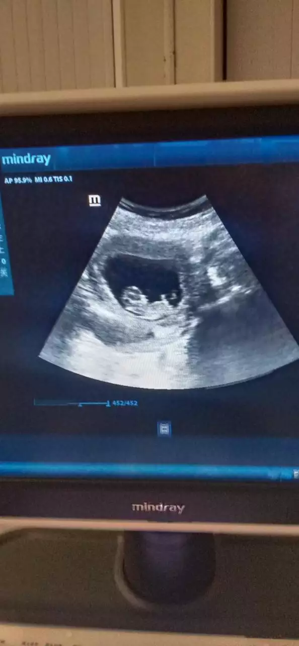 4、如何知道肚子里是男孩还是女孩