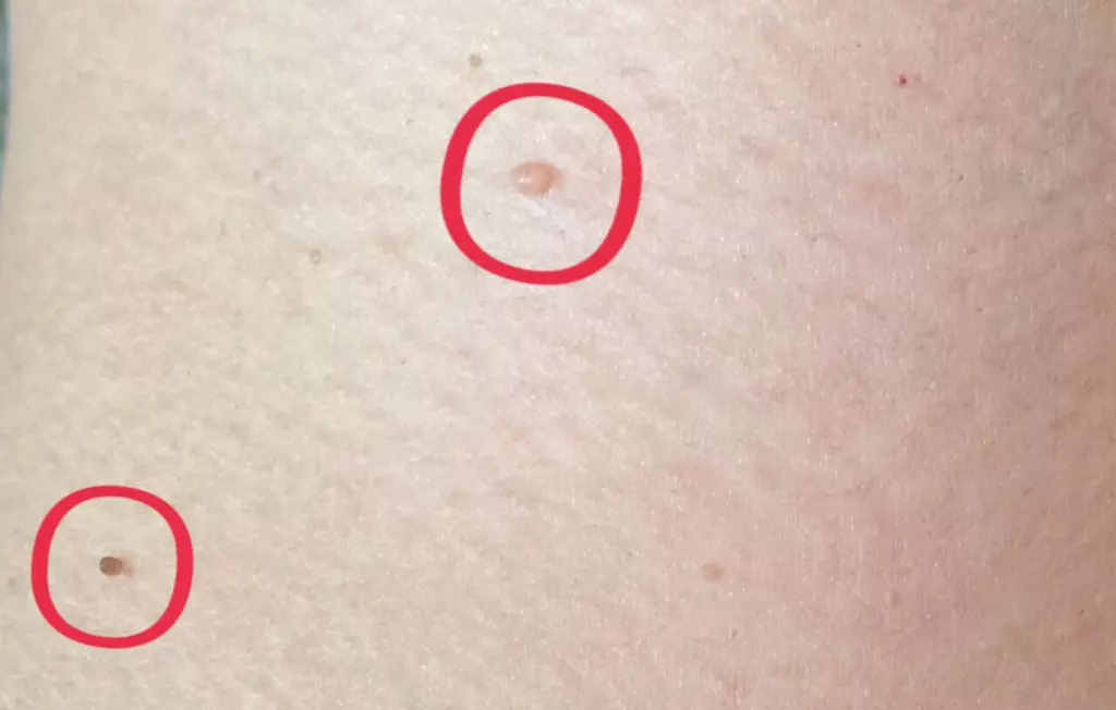 4、丝状疣防治误区，都有哪些？