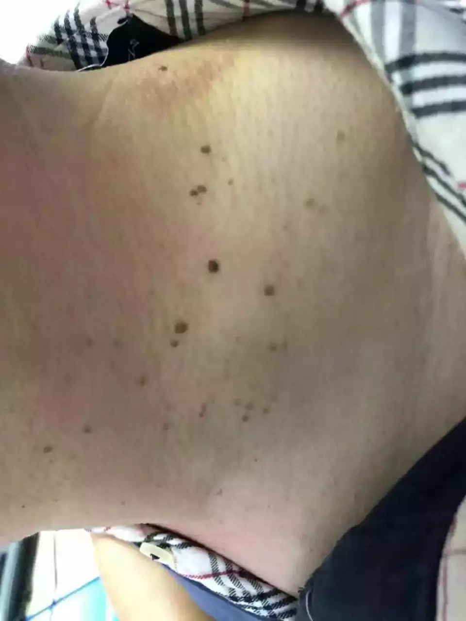 3、脖子上的丝状疣是怎么引起的