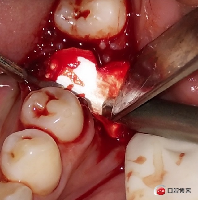 2、内黄看好牙牙科诊所—牙髓发炎的危害？
