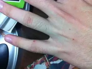 3、白血病的症状和前兆，你都知道哪些？