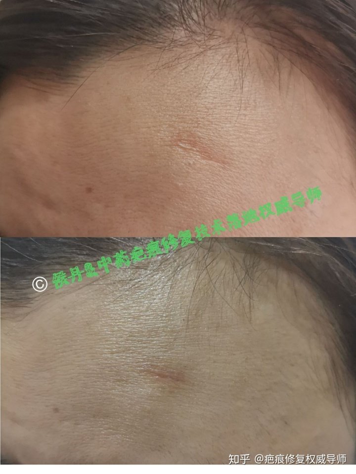 2、额头有疤痕的怎么样?