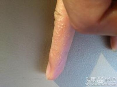 2、手指上有水泡