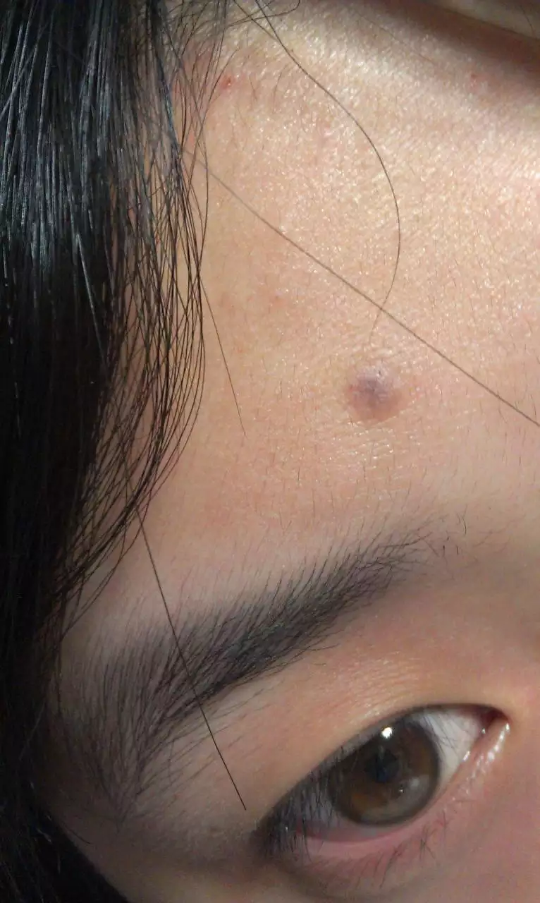 3、额头上有疤痕会影响财运吗?会对个人运势产生影响吗