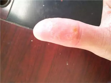 3、手指里面有水泡是怎么回事呢