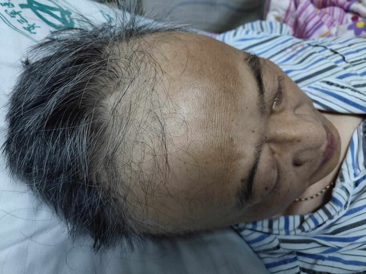2、晚期肺癌小细胞癌大概能活多久