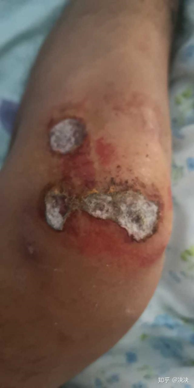 2、伤口五天结痂化脓需要把结痂移除么？图片一属于结痂化脓么？另外阿莫西林没外用么？