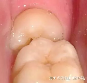 3、风水学女人长智齿好吗