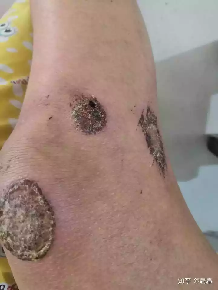 4、怎么判断痂下是否化脓