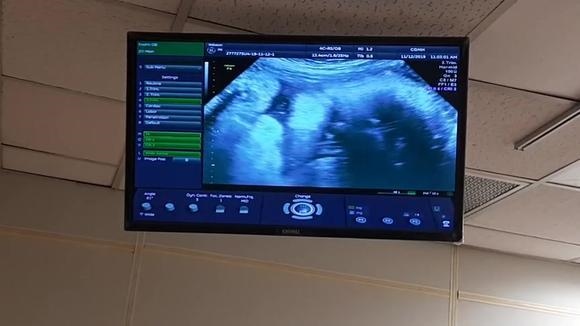 2、胚胎12周发育情况