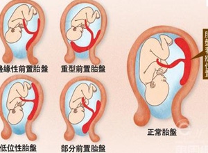 2、怀孕时，的前壁和后壁有什么不一样？